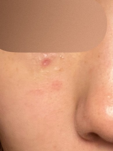 after photo: CO2レーザー, ほくろ除去(レーザー)
