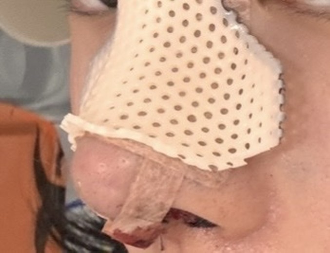 after photo: 콧대(보형물), 코끝(자가연골)