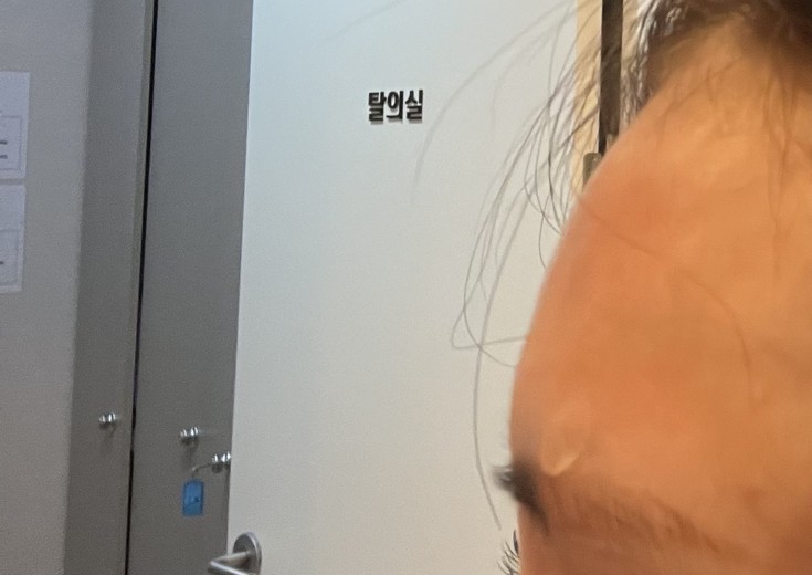 after photo: 이마필러, 관자놀이필러