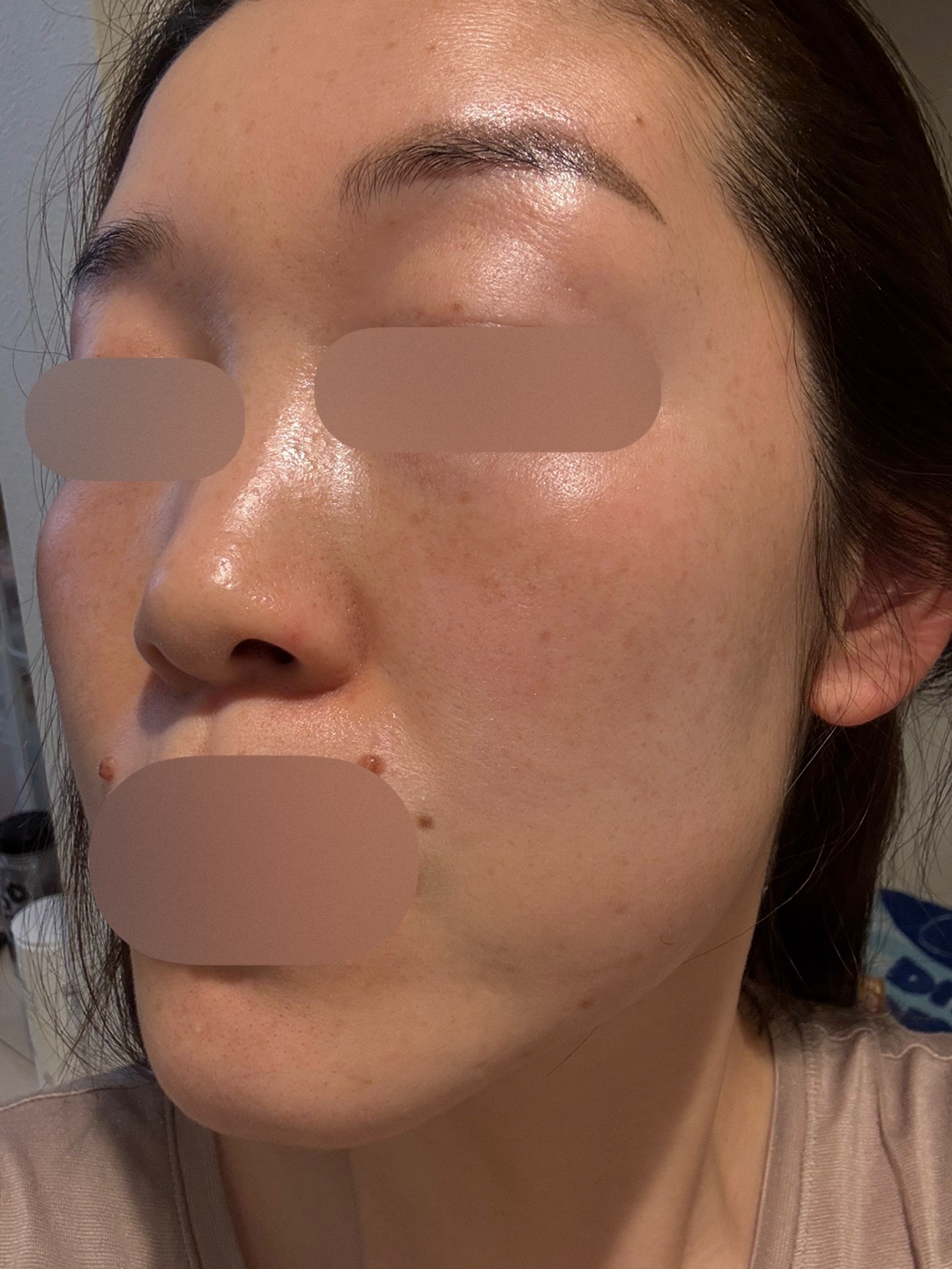 ピコトーニング＋マッサージピール【2月15日迄にご予約頂いた方】 | ZX