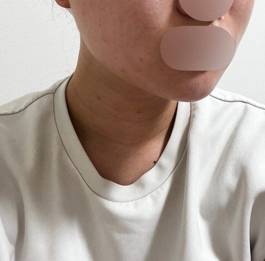 after photo: 脂肪吸引注射
