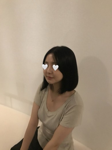 after photo: 콧대(보형물), 코끝(자가연골)