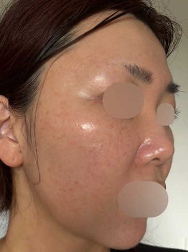 after photo: IPL(光/フォト治療), ルメッカ