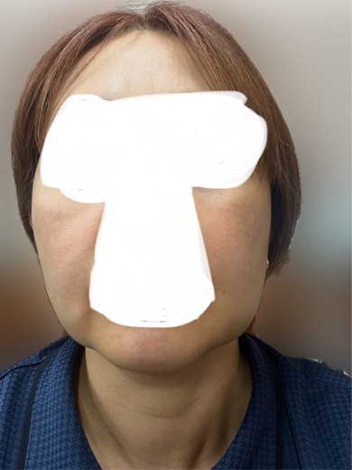 after photo: 脂肪溶解注射(顔)