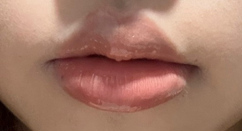 after photo: 입술필러