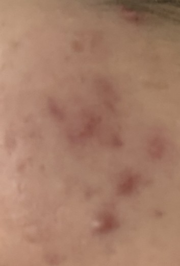 before photo: 여드름압출, 여드름주사