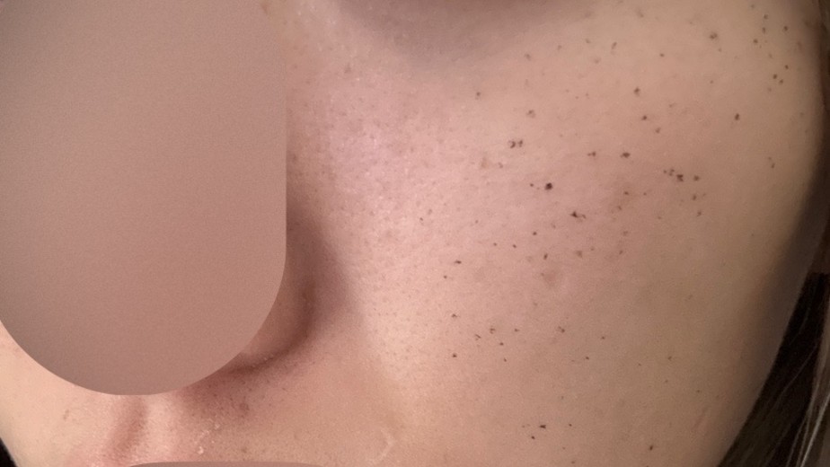 after photo: IPL(光/フォト治療), 診断・検査