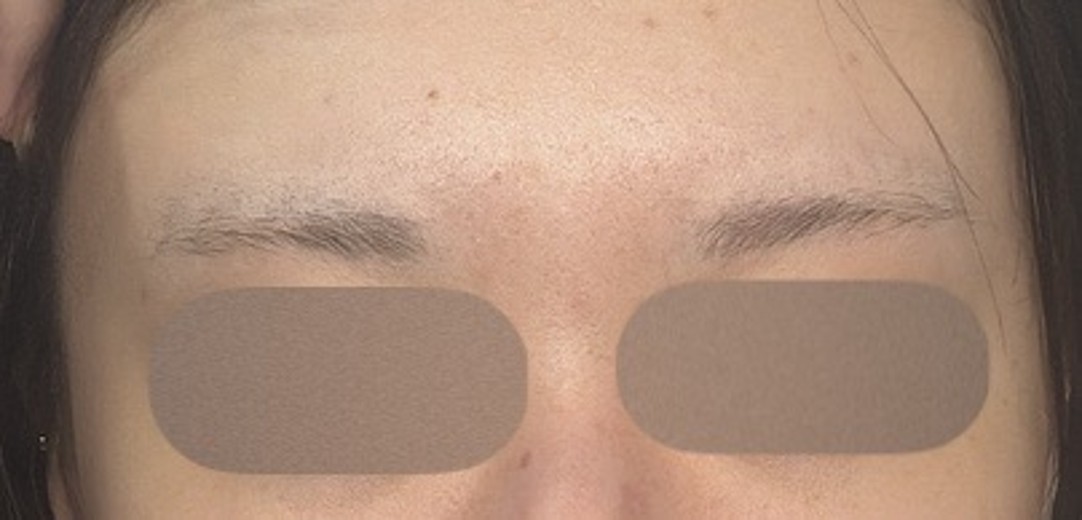 before photo: 眉間ボトックス