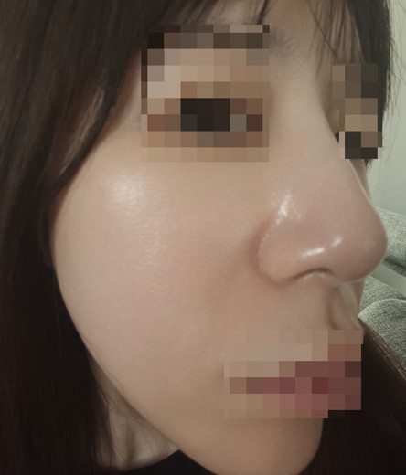 after photo: IPL(光/フォト治療), ピーリング, エレクトロポレーション