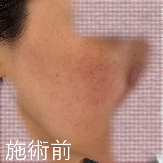 before photo: ルメッカ