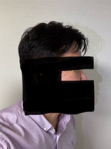 after photo: 눈밑지방재배치