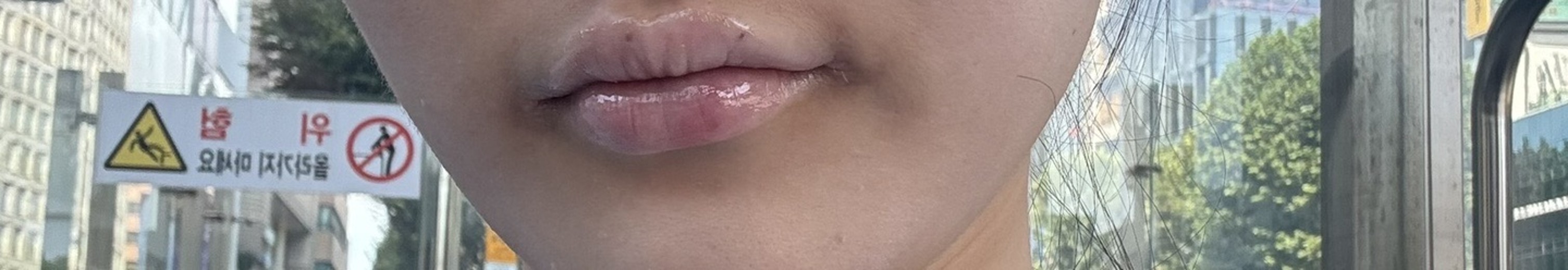 after photo: 입꼬리필러, 입술필러