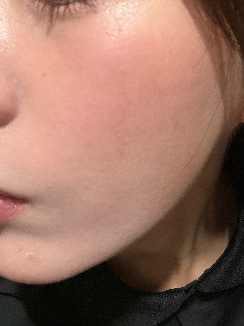 ハイドラフェイシャル＋ケアシス｜トラネキサム酸導入｜全顔 | こまち