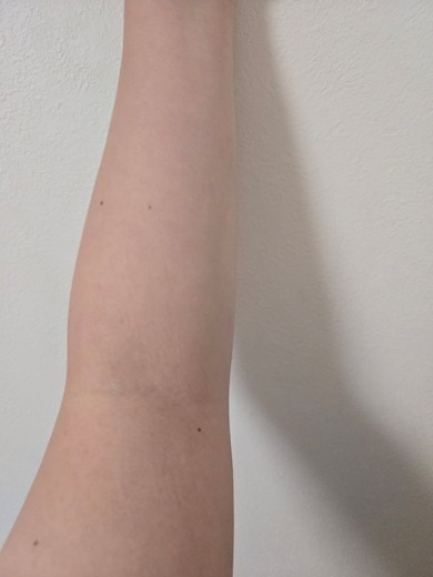 after photo: 白玉注射・点滴, 美容注射・点滴