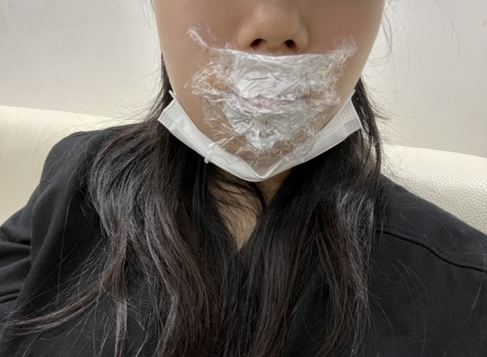 after photo: 입술필러