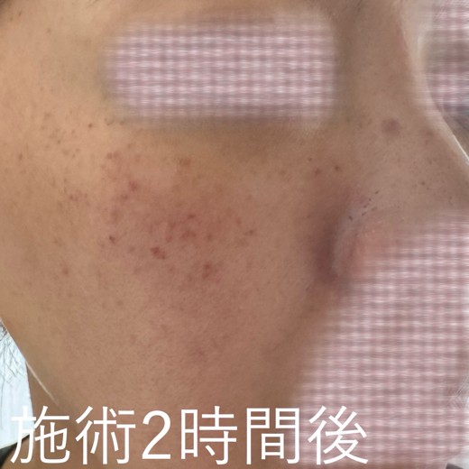 after photo: ルメッカ