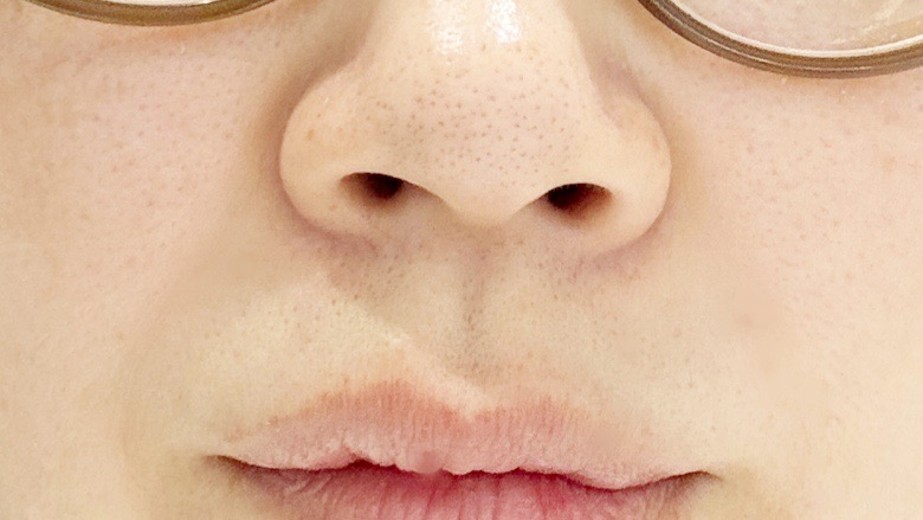 before photo: 小鼻ボトックス, 鼻先ボトックス
