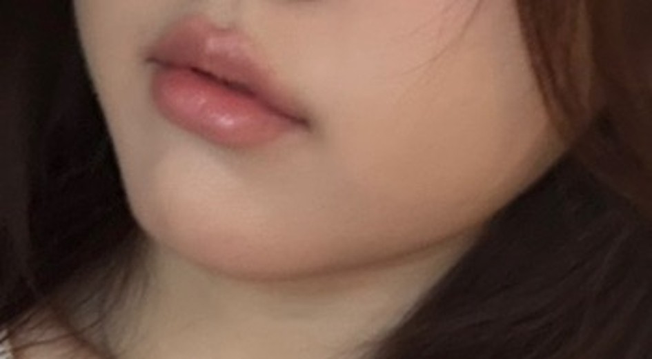 after photo: 윤곽주사, 사각턱보톡스