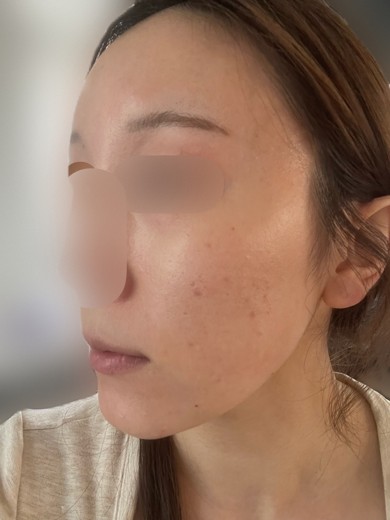 after photo: ピーリング, エレクトロポレーション