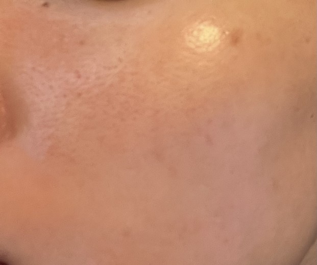 after photo: 白玉注射・点滴, ルメッカ
