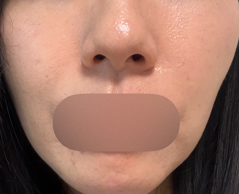 水光注射｜肌育ボト水光プレミアム | 城本クリニック 大宮院