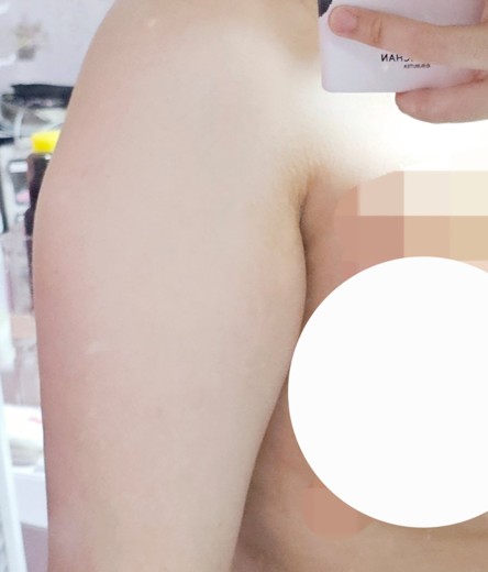 before photo: 러브핸들지방흡입, 복부지방흡입