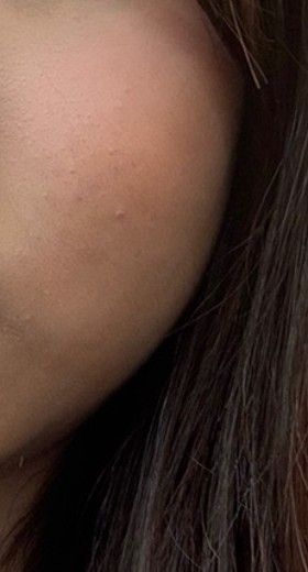 after photo: 인모드리프팅