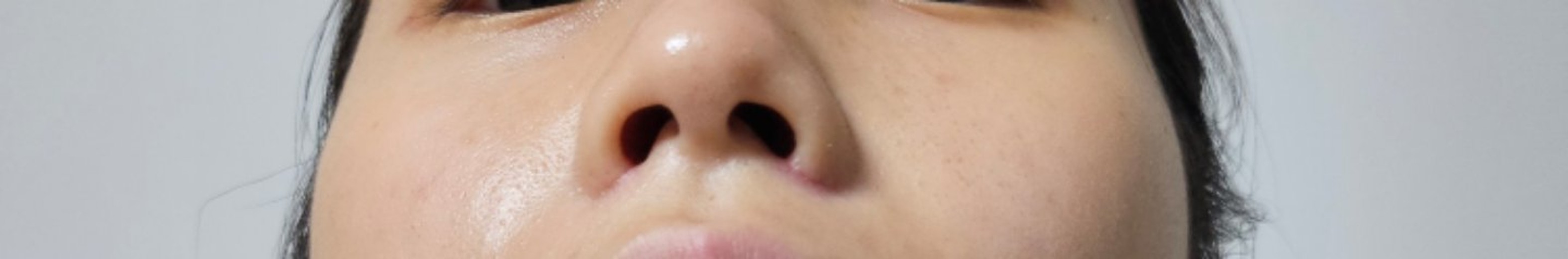 after photo: 콧볼축소