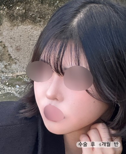 after photo: 콧대(자가조직), 코끝(자가연골)