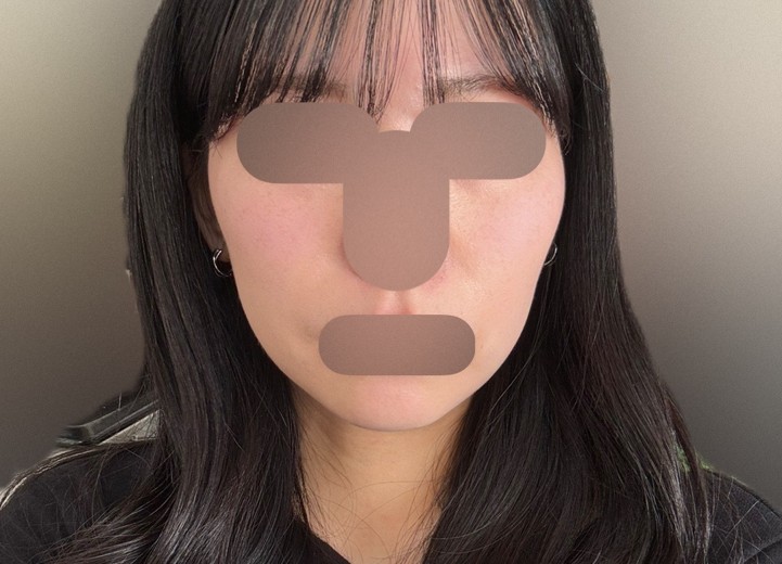 before photo: 糸リフト