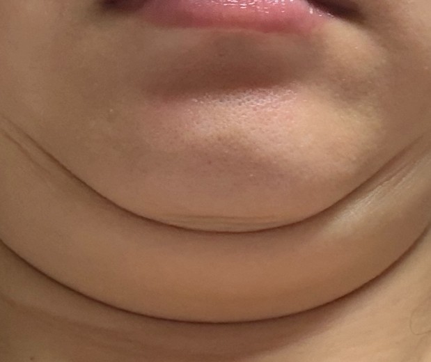 before photo: 얼굴지방분해주사