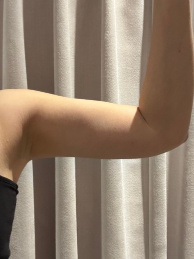 before photo: 脂肪溶解注射(腕)