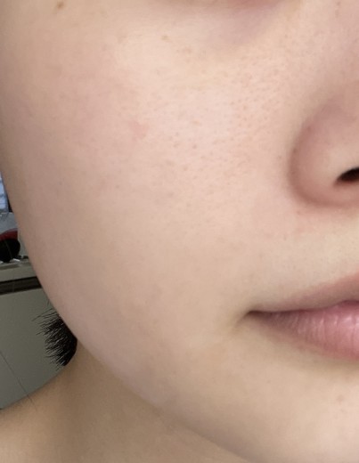after photo: IPL(光/フォト治療), ルメッカ