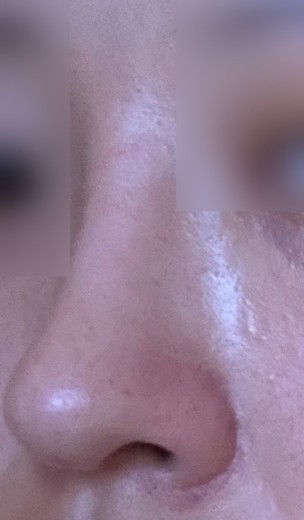 after photo: 콧대(보형물), 코끝(자가연골)