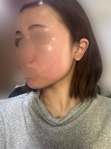 before photo: ビタミン注射・点滴