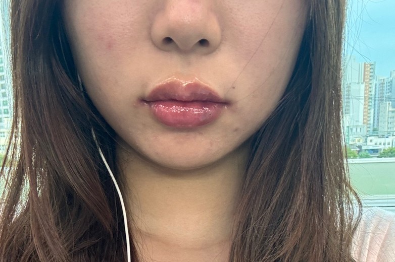 after photo: 입꼬리필러, 입술필러