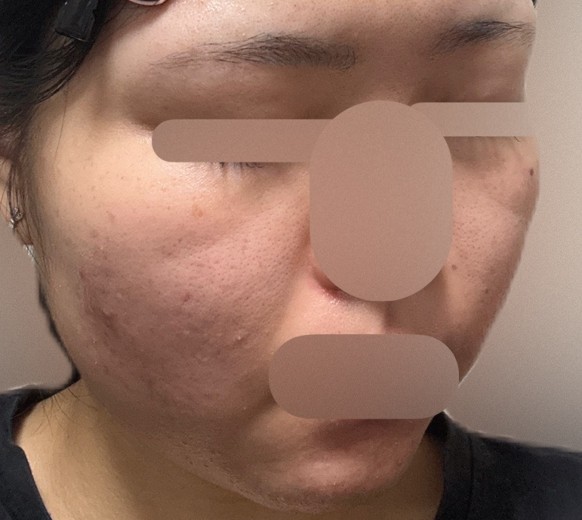 after photo: IPL(光/フォト治療)