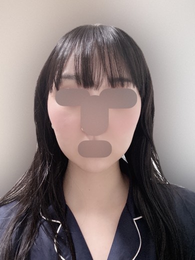 after photo: 脂肪溶解注射(顔)
