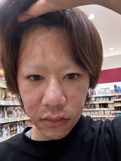 after photo: ダーマペン