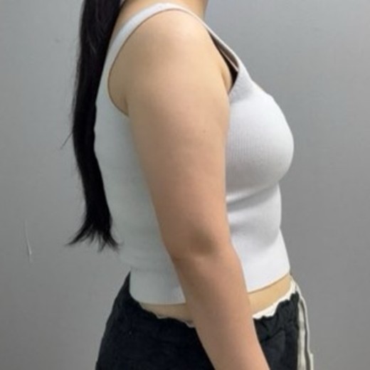 before photo: 脂肪溶解注射(腕)