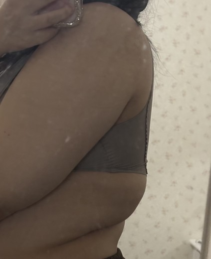 after photo: 脂肪冷却(腕)