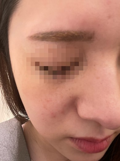 after photo: レーザートーニング