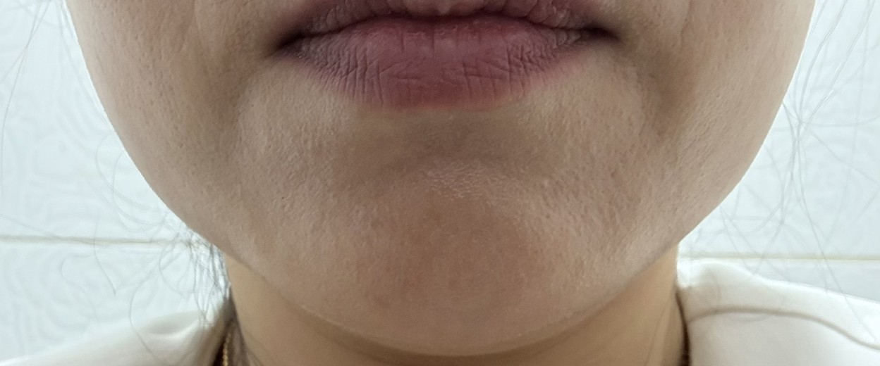 after photo: 윤곽주사