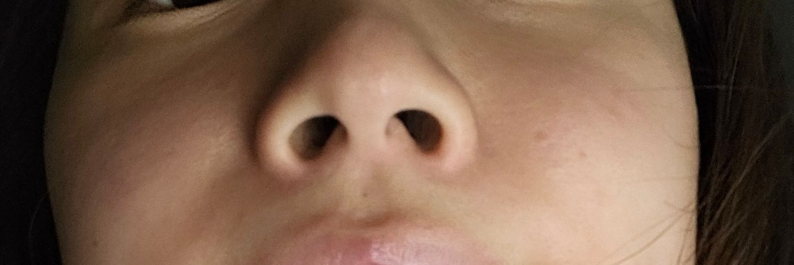 before photo: 콧볼축소