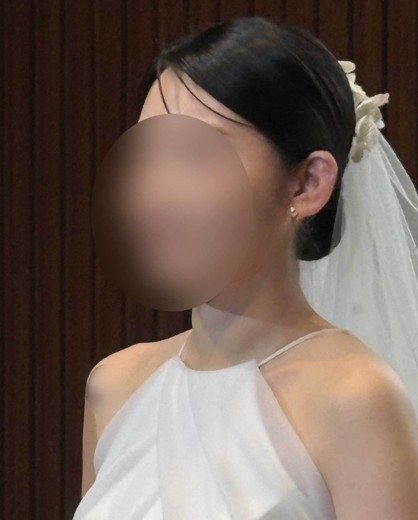 after photo: 귀필러