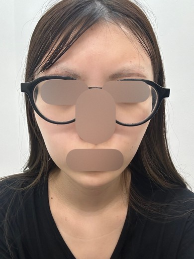 before photo: イオン導入