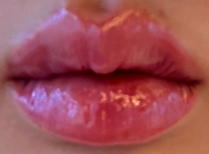 after photo: 입술필러