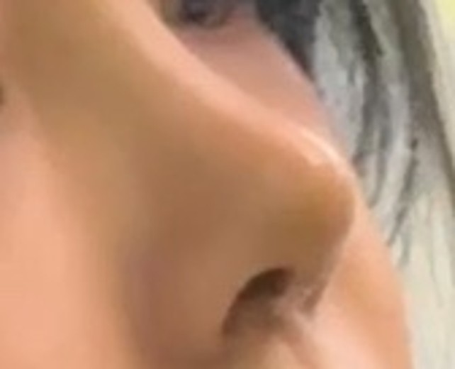 after photo: 콧대(보형물), 코끝(자가연골)