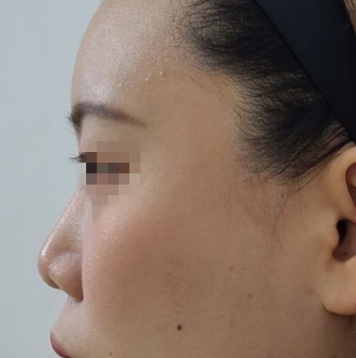 after photo: 코재수술(실리콘제거)