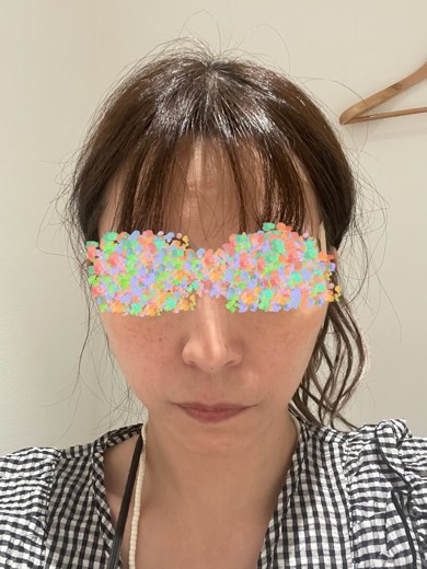 before photo: サーマクール(高周波)